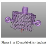 Figure 3. A 3D model of jaw implant 