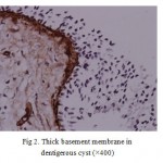 Fig 3. Thin basement membrane in keratocystic odontogenic tumor 