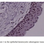 Fig 4. Score 1 in the epithelial keratocystic odontogenic tumor (×400)
