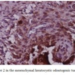 Fig 6. Score 2 in the mesenchymal keratocystic odontogenic tumor (×400)