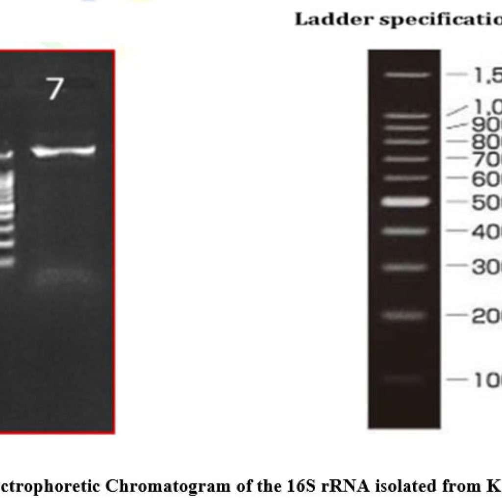 Pathophysiology Of Multidrug Resistant Klebseilla Pneumoniae Causing Uti Infection In Pregnant 5342